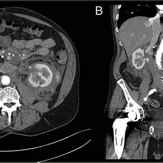 A Axial Section Of The Abdominal And Pelvic Ct Demonstrating