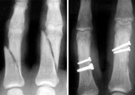 Hand Fractures Orthoinfo Aaos