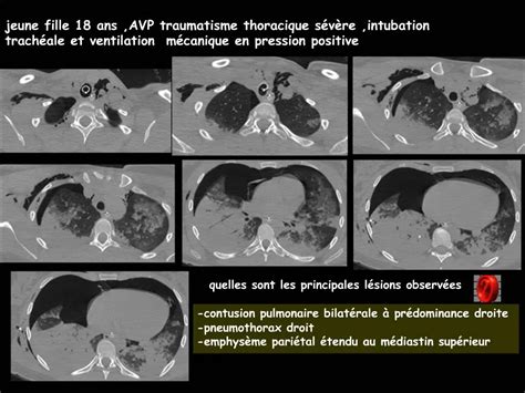 Ppt Jeune Fille Ans Avp Traumatisme Thoracique S V Re Intubation