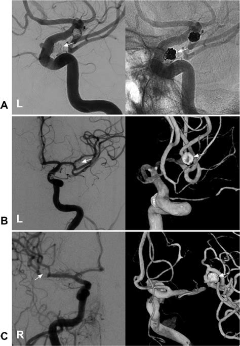 Follow Up Angiographic Outcome Of Three Aneurysms A Dsa Left Panel