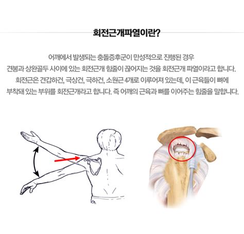 마디사랑병원 질환별 소개 어깨 회전근개파열