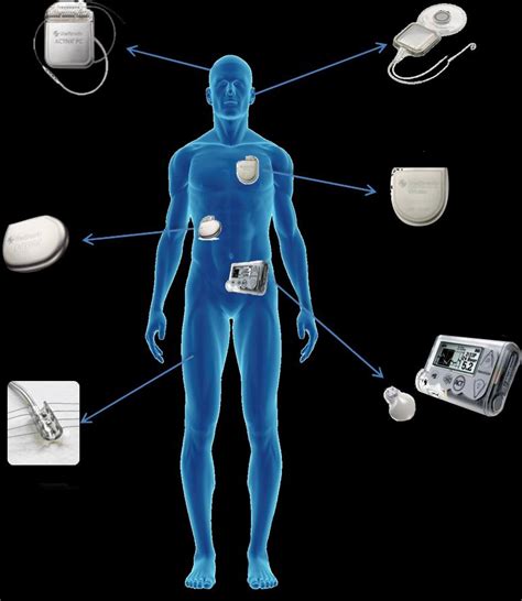 Implantable Medical Devices Market 2022: Industry Growth,