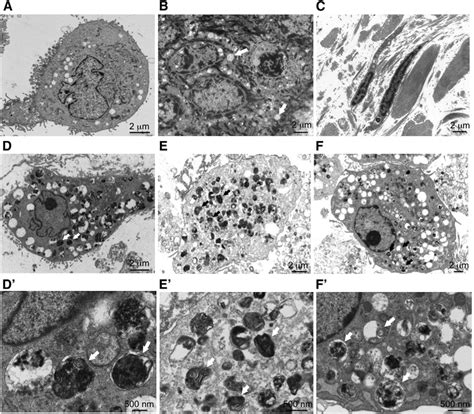 Electron Micrographs Of Skin Biopsy And Cultured Fibroblasts A