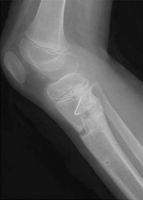 Resection Of A Physeal Bar With Complete Transverse Osteotomy At The