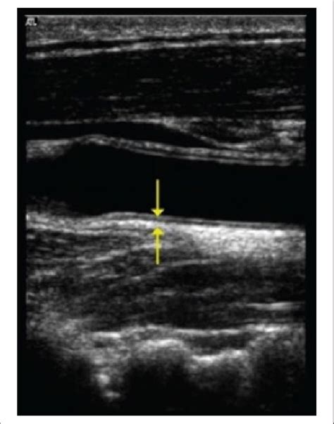 Sagittal Gray Scale Image Of The Distal Common Carotid Artery Showing