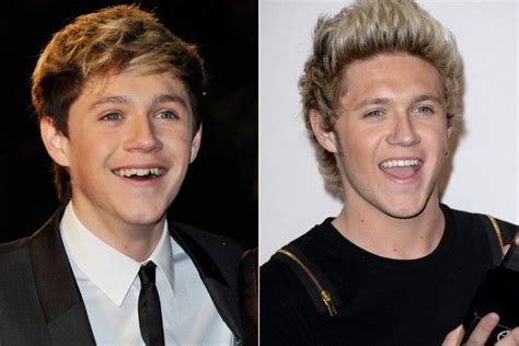 Celebrities Teeth Transformations Before And After PHOTOS Niall