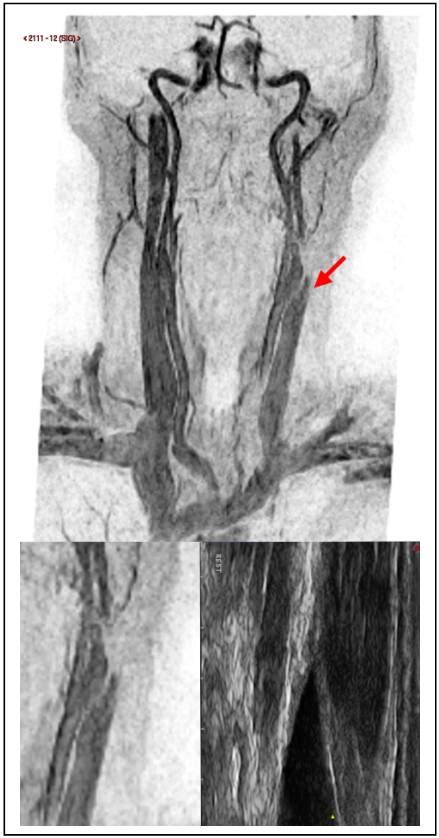 Chronic Cerebrospinal Venous Insufficiency Angiologist