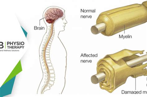 What Is Guillain barré Syndrome GBS Symptoms Causes Diagnosis