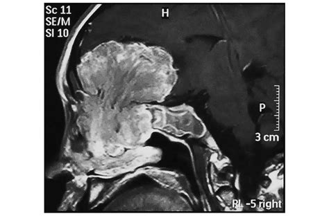 Primary Intracranial Neuroendocrine Tumor With Ectopic