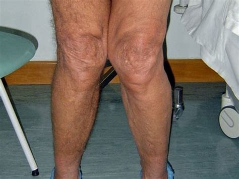 Treatment for Knee Osteoarthritis - Injection Clinic Sheffield Barnsley