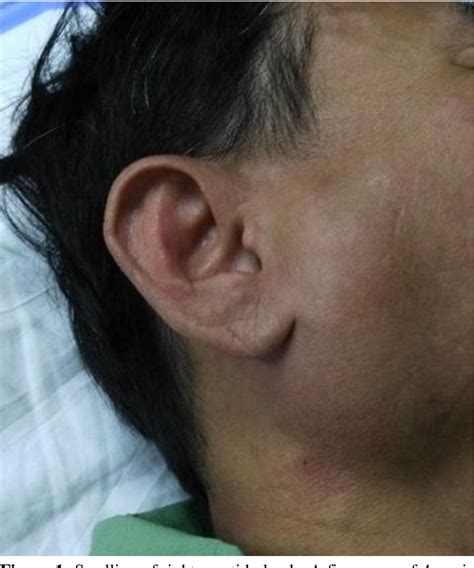 Figure From Transient Unilateral Parotid Gland Swelling Following