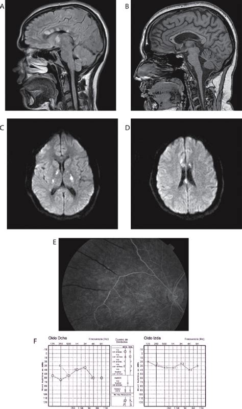 Sex Hormones Secondary Players In Susac S Syndrome Multiple Sclerosis And Related Disorders