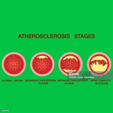 Atherosclerosis Stagesthe Accumulation Of Cholesterol In The Blood