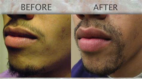 Chicago Il Facial Hair Transplant Gallery Dr Yates Hair Science