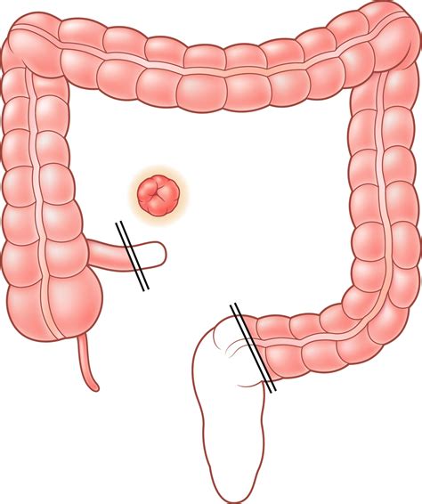 Management Of Crohns Disease And Ulcerative Colitis Surgery Oxford