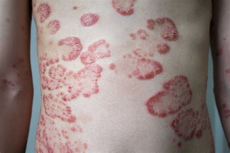 Psoriasi Sintomi Cause Rimedi E Prevenzione Eucerin