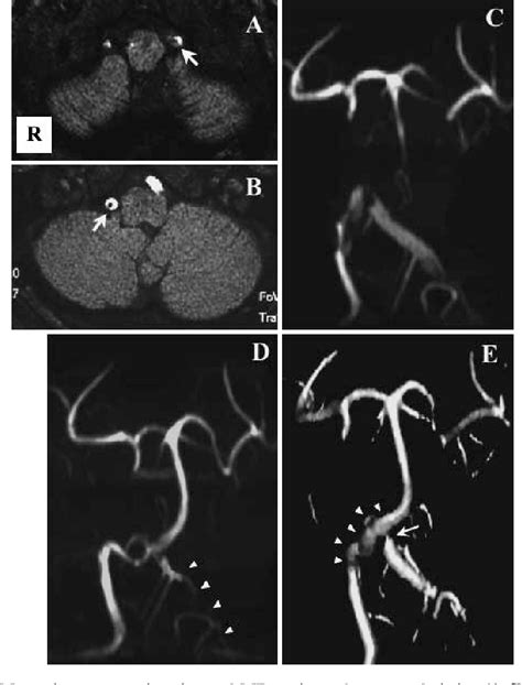 Figure 1 From Dissection Of Bilateral Intracranial Vertebral Artery With Basilar Artery