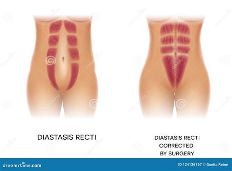 Diastasis Recti D Medical Illustration On White Background Royalty