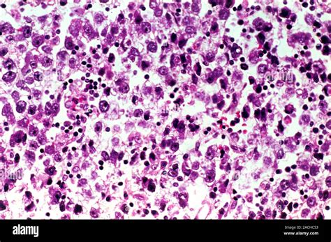 Testicular Cancer Light Micrograph Of A Section Through A Seminoma