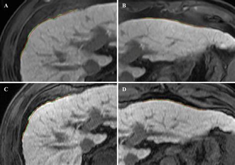 An Example Of Liver Surface Nodularity Lsn Measurement Of A Download Scientific Diagram