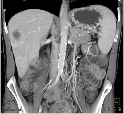 Pancreatic Neuroendocrine Tumor Pnet Of The Tail Of The Pancreas With