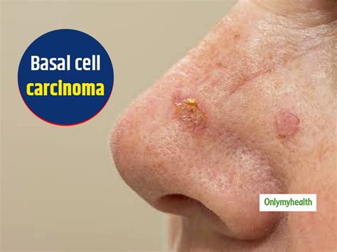 Basal Cell Carcinoma Symptoms Causes And Treatment By Oncologist Dr Ashok Vaid Onlymyhealth