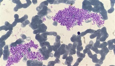 Platelet clumps in peripheral blood smear from blood sample collected ...