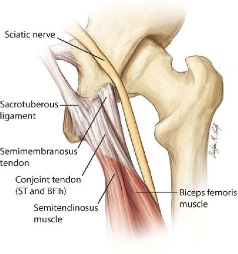 Figure From Rehabilitation And Prevention Of Proximal Hamstring