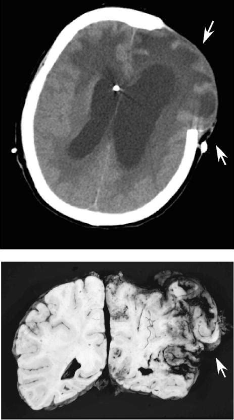 Complications Of Decompressive Craniectomy For Traumatic Brain Injury