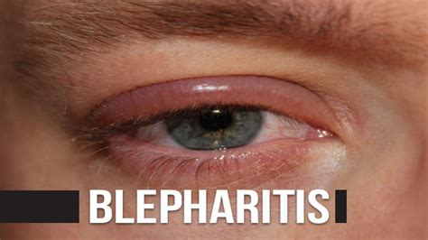 Blepharitis Eyelid Inflammationcauses Types Symptoms Diagnosis