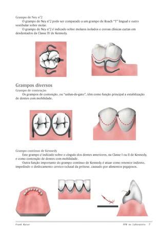 Pr Tese Parcial Remov Vel Odontol Gico Pdf