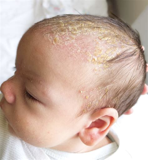 Guest Blog Understanding Common Newborn Rashes Willbys