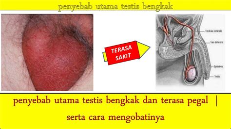 Testis Yang Tertarik Di Antara Perut Dan Paha YouTube