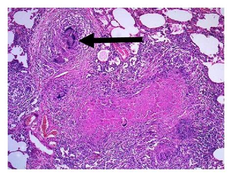 Arrow indicating caseating granuloma. | Download Scientific Diagram