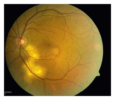 Chorioretinitis Is Seen To Be Regressing Download Scientific Diagram