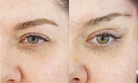 Before And After Fox Eye Thread Lift Contour Clinics