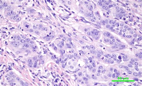 Neoplastic Cells With Round To Ovoid Nuclei Prominent Nucleoli And