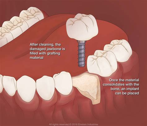 Bone Grafting Jackson Ms Clinton Ms Ridgeland Ms Periodontal