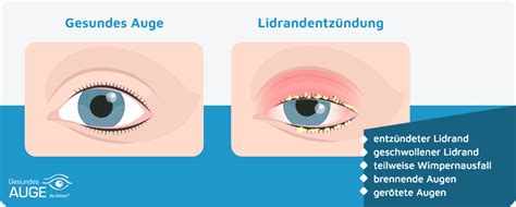 Augenentzündungen im Überblick kanyo