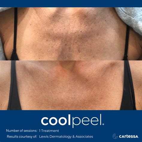 Cool Peel Co2 Laser Resurfacing — The Skin Spot Laser Club Cape Coral S Top Rated Med Spa