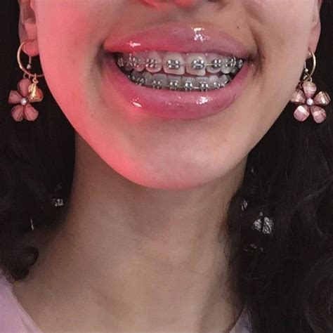 Nayema🕊 Cute Braces Colors Braces Girls Brace Face