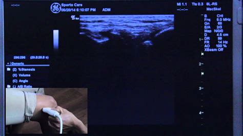 Msk Ultrasound Knee Diagnosis Orange County Huntington Beach Youtube