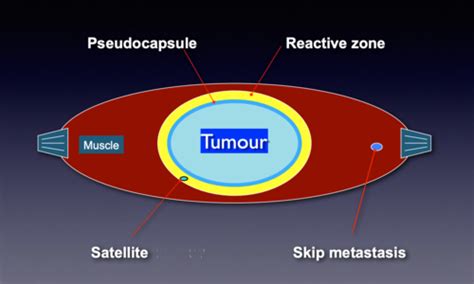 Musculoskeletal Neoplasia Not Finished Flashcards Quizlet