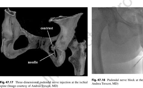 Pudendal Nerve Block Showing Spread Into Pudendal Artery Youtube