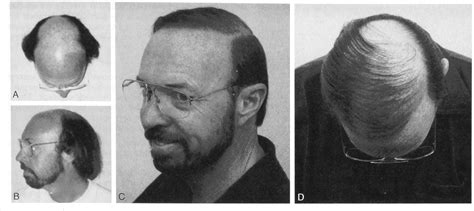 Figure 1 From The Frontal Forelock Concept In Hair Transplantation Semantic Scholar