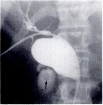 Choledochal Cyst Involving Common Bile Duct Type Ia A Percutaneous