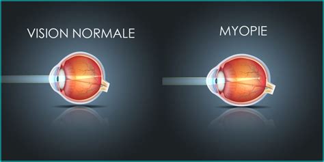 La Myopie Traitement De La Myopie Au Laser Ophtalmologie Var