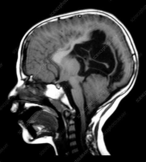 Arnold Chiari Malformation Stock Image M1300954 Science Photo