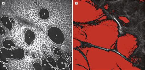 In Vivo Confocal Microscopy Of Filtering Blebs After Trabeculectomy