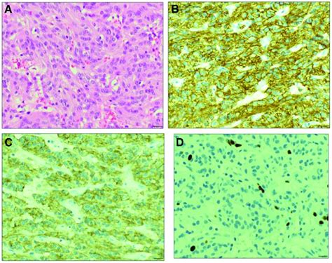 Histological Sections Of Gist And Immunostaining In Patient 1 A Download Scientific Diagram